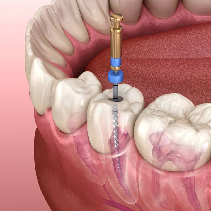 Endodonti & Kanal Tedavisi