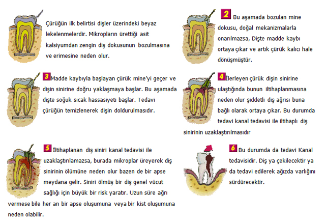 Diş çürüğü nasıl oluşur?